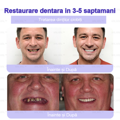 XRLXRL™ Praf Mineral pentru Restaurarea Dentară - Recomandat de ADA (🦷Reducere limitată, mai rămân 30 de minute🦷)