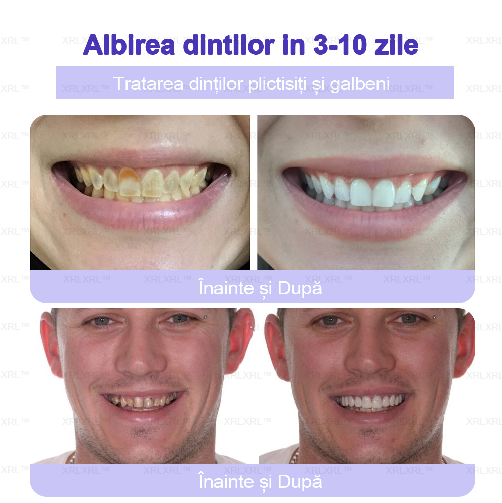 XRLXRL™ Praf Mineral pentru Restaurarea Dentară - Recomandat de ADA (🦷Reducere limitată, mai rămân 30 de minute🦷)