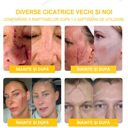 Velisse™ Cremă cu Venin de Albine, pentru Îndepărtarea Papiloamelor, Acneei și Cicatricilor - Tratament pentru Multe Probleme Ale Pielii (Recomandat de ADD)